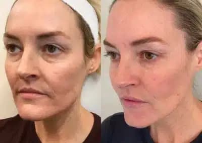left oblique view full face filler before and after photos by awskinco pt