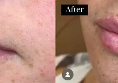 left oblique view lip filler before and after photos by awskinco pt