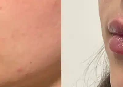 left oblique view lip filler before and after photos by awskinco pt