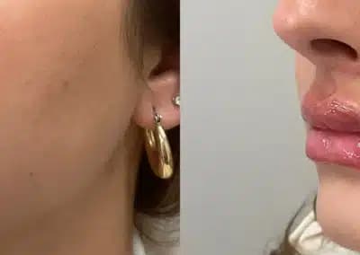 left oblque view lip filler before and after photos by awskinco pt