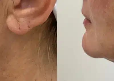 left side view lower face filler before and after photos by awskinco pt