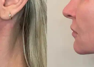 left side view lower face filler before and after photos by awskinco pt