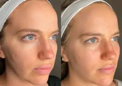right oblique view full face filler before and after photos by awskinco pt