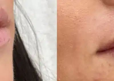 right oblique view lip filler before and after photos by awskinco pt