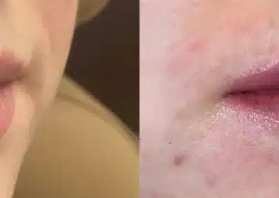 right oblique view lip filler before and after photos by awskinco pt