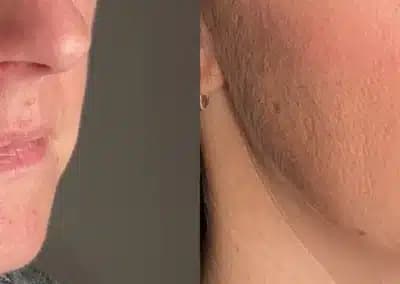right oblique view lip filler before and after photos by awskinco pt