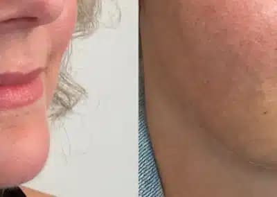 right oblique view lip filler before and after photos by awskinco pt