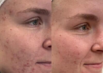 right oblique view microneedling+chemical peels before and after photos by awskinco