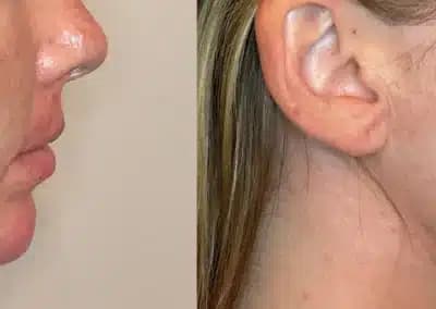 right side view lower face filler before and after photos by awskinco pt