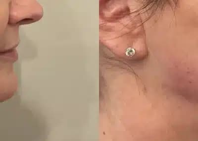 right side view lower face filler before and after photos by awskinco pt