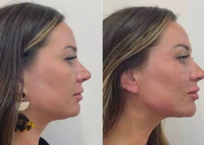 right side view lower face filler before and after photos by awskinco pt