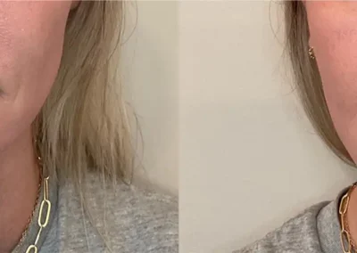 chin filler before and after photos by awskinco+ in murfreesboro tn