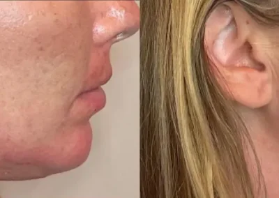 jawline filler before and after photos by awskinco+ in murfreesboro tn