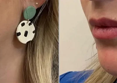 jawline filler before and after photos by awskinco+ in murfreesboro tn