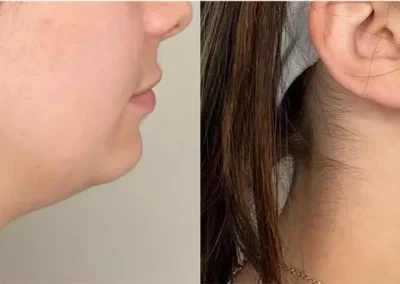 jawline filler before and after photos by awskinco+ in murfreesboro tn