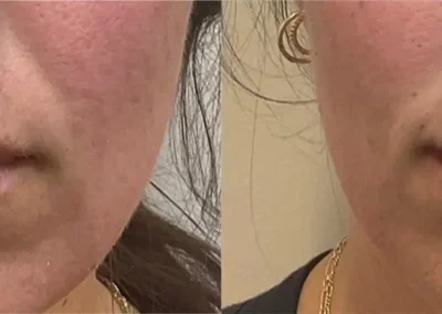 lips fillers before and after photos by awskinco+ in murfreesboro tn