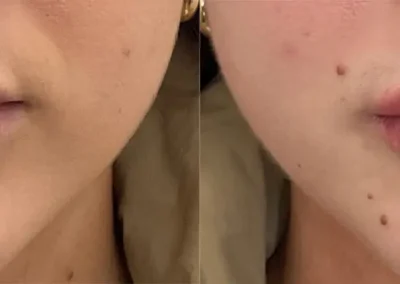 lips fillers before and after photos by awskinco+ in murfreesboro tn