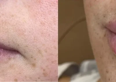 lips fillers before and after photos by awskinco+ in murfreesboro tn
