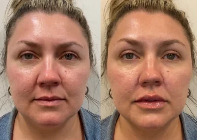 lips fillers before and after photos by awskinco+ in murfreesboro tn