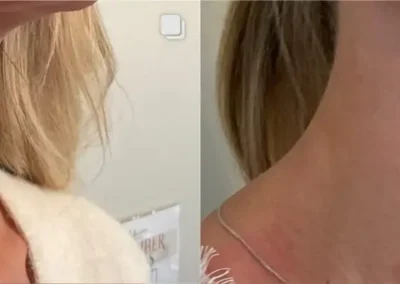 radiesse before and after photos by awskinco+ in murfreesboro tn