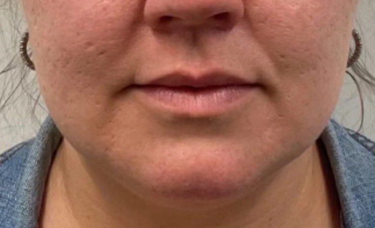 Before Results of a AWSkinCo+ patient that received Dermal Filler treatment on their lips.