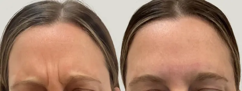 botox at awskinco before and after results