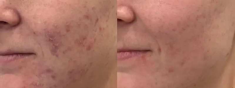 chemical peels at awskinco before and after results