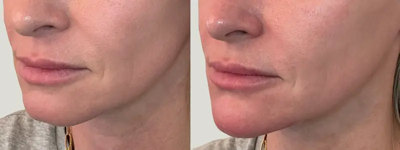 chin filler at awskinco before and after results