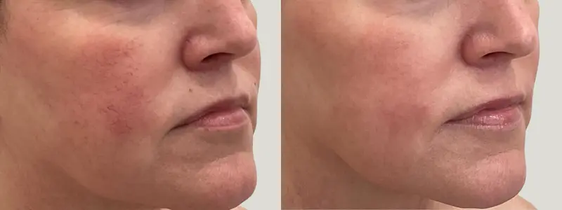 ipl at awskinco before and after results