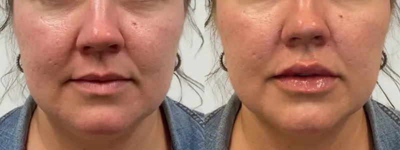 lip filler at awskinco before and after results