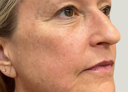 After Results of a AWSkinCo+ patient that received Microneedling treatment on their face.
