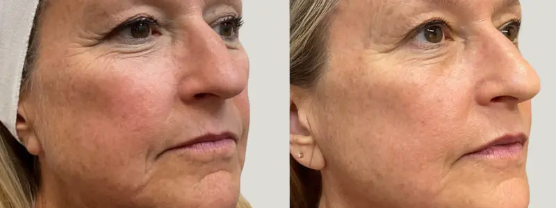 microneedling at awskinco before and after results